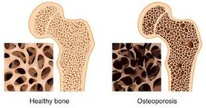 kaulų osteoporozė